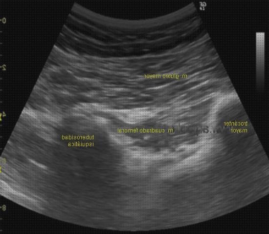 Las mejores ecografica anatomia ecografica de gluteos