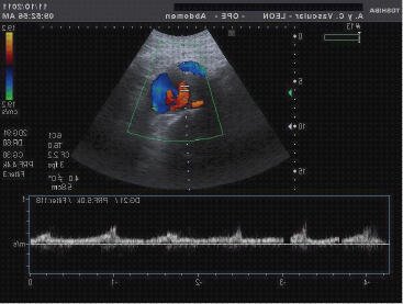 Los mejores 5 Ecos Colores Doppler Aortas Abdominales