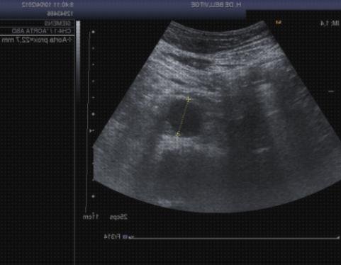 Las mejores colores ecos doppler eco color doppler aorta abdominal