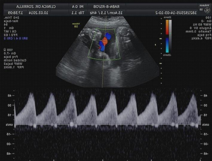 Las mejores ecos doppler eco doppler aparato