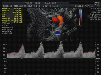 Los 9 Mejores Ecos Doppler Arterias Uterina