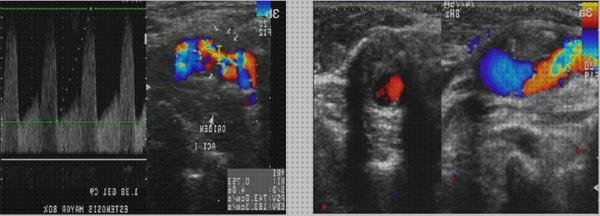 TOP 14 ecos doppler aterosclerosis