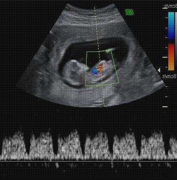 Análisis de los 19 mejores Ecos Doppler Colores Fetal