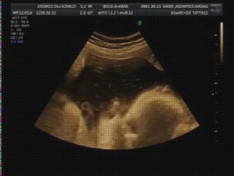 Las mejores marcas de eco doppler fetal ecografía doppler eco doppler color fetal