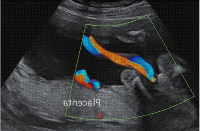 Los 13 Mejores Ecos Doppler Crecimientos Fetal