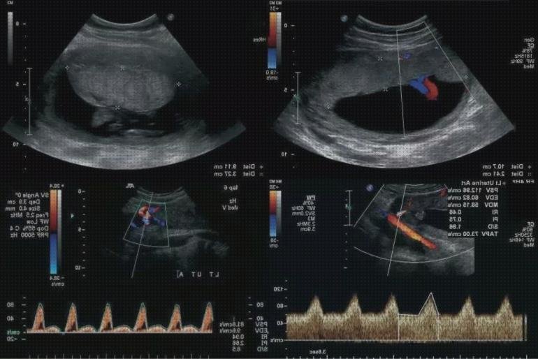 Análisis de los 8 mejores Ecos Doppler De Arterias Uterinas