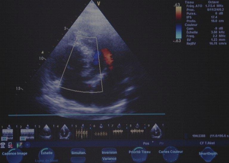 Las mejores eco doppler arterias cerebrales Mas eco doppler transtoracico ecografía doppler eco doppler de arterias viscerales