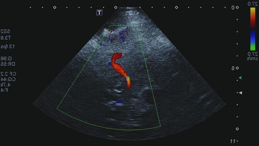 Las mejores dtc doppler eco doppler dtc