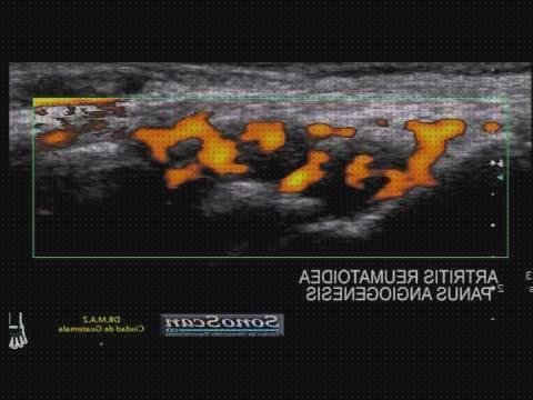 Los mejores 8 Ecos Doppler En Artritis