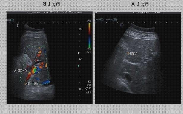 Las mejores doppler eco doppler esofagico