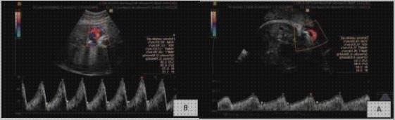 Las mejores marcas de fetal doppler eco doppler fetal arteria umbilical