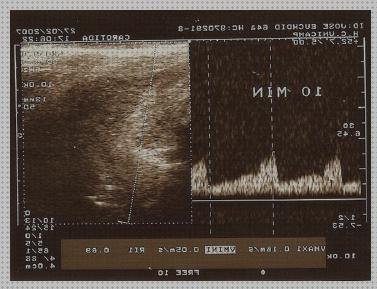 Las mejores doppler eco doppler gca