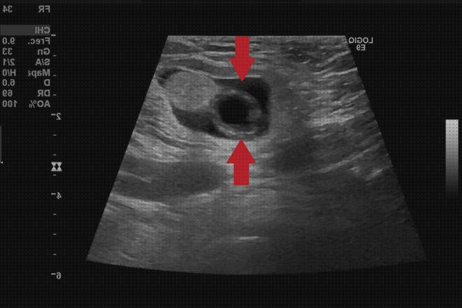 Las mejores marcas de doppler eco doppler inguinal