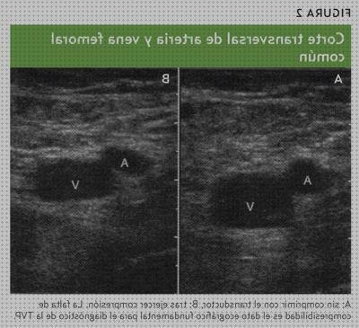 Las mejores marcas de doppler eco doppler mmll