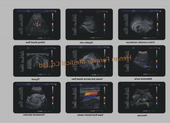 Las mejores eco doppler thyroid