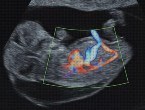 Los mejores 22 Ecos Doppler Y Ecografias