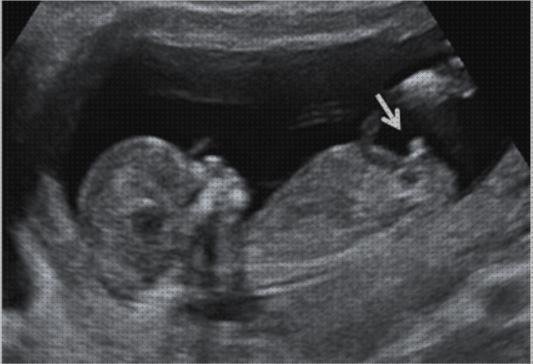 Opiniones de ecografía once semanas ecografía 12 semanas 11 semanas mas 2