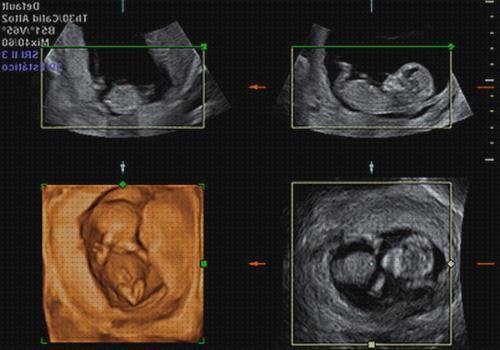 TOP 9 ecografías 21 semanas