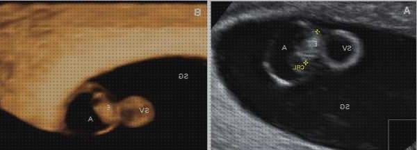 ᐉ 16 Mejores Ecografías 6 Semanas De Embarazos Corazones 【opiniones】 