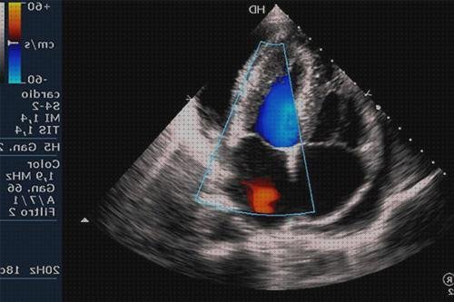 Las mejores ecografia eco doppler ecografía doppler ecografía con doppler color
