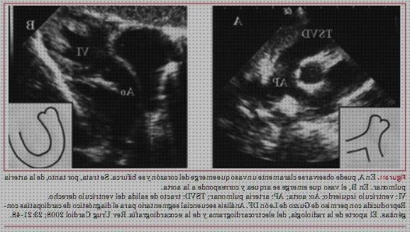 Las mejores arterias ecografía de lad arterias