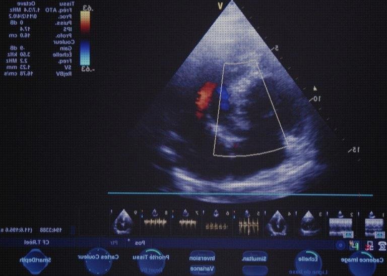 Opiniones de ecografias doppler ecografía doppler de flujo sanguíneo