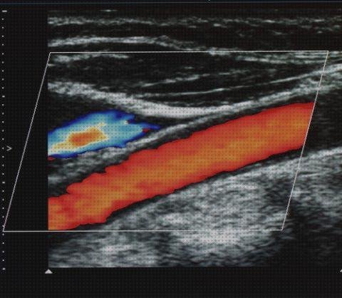 Las 20 Mejores Ecografías Doppler Rojos