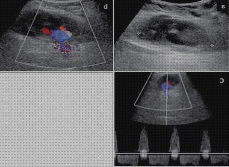 Review de ecografía doppler rojo