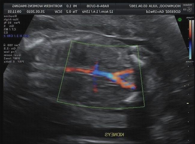 Las mejores marcas de ecografía doppler ecografia eco doppler fetal