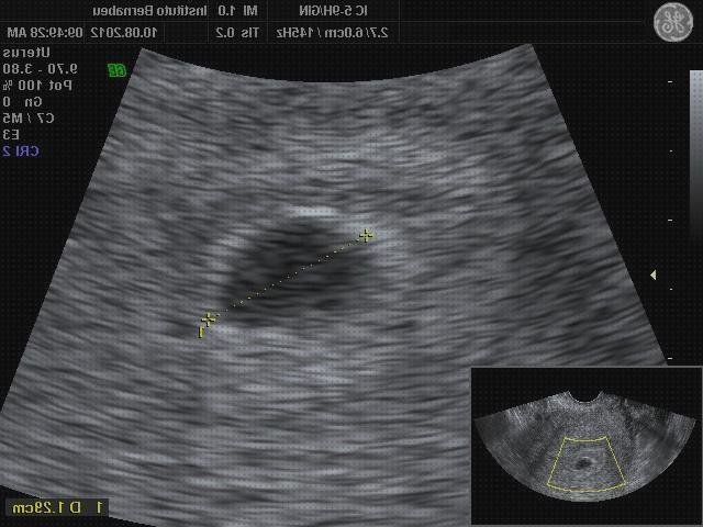 Review de ecografía embarazo antes de la fecundación