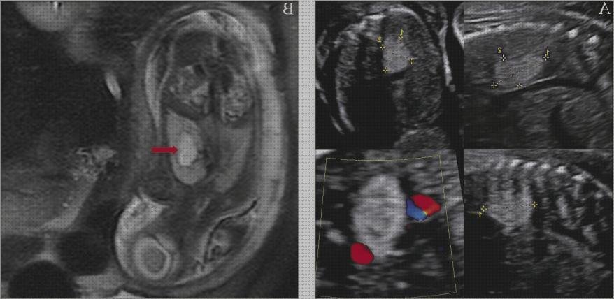 Las mejores fetal ecografía opper fetal