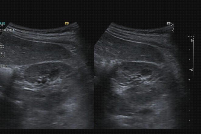 Opiniones de urinarias ecografía renal y de vías urinarias