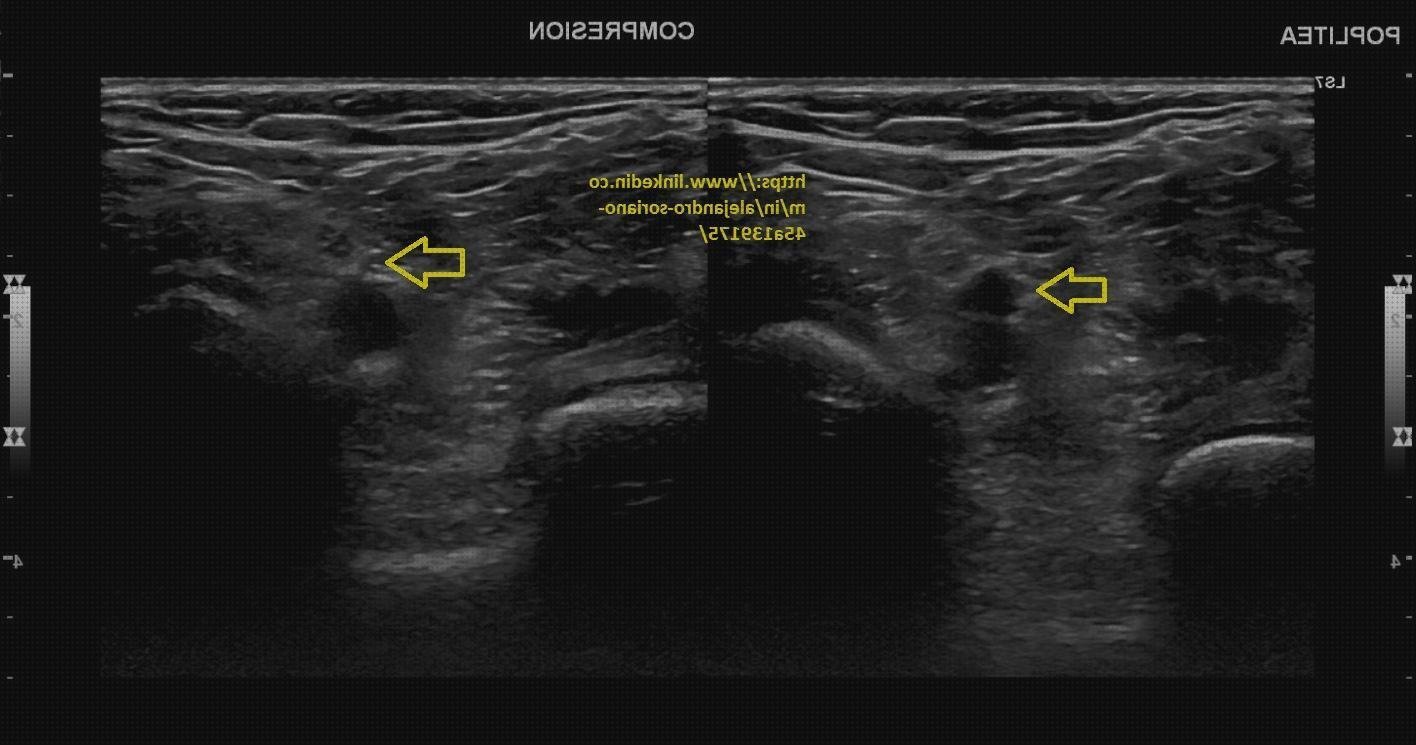 Las mejores ecografía vasos popliteos
