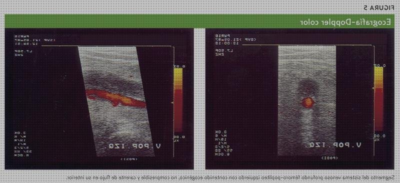 Review de ecografía vasos popliteos