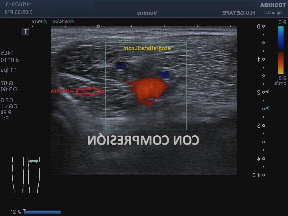 Opiniones de las 4 mejores Ecografías Vasos Popliteos