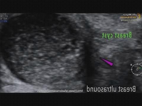 Las mejores marcas de ecografias doppler ecografía doppler mama color