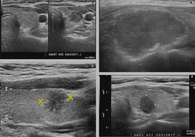 Opiniones de ecografia caraceteristicas ecograficas ecograficas de nodulos tiroideos malignos y benignos
