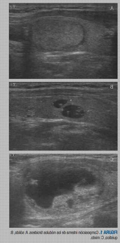 Donde comprar ecograficas de nodulos tiroideos malignos y benignos