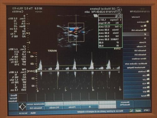 Review de ecografo samsung 18 mhz