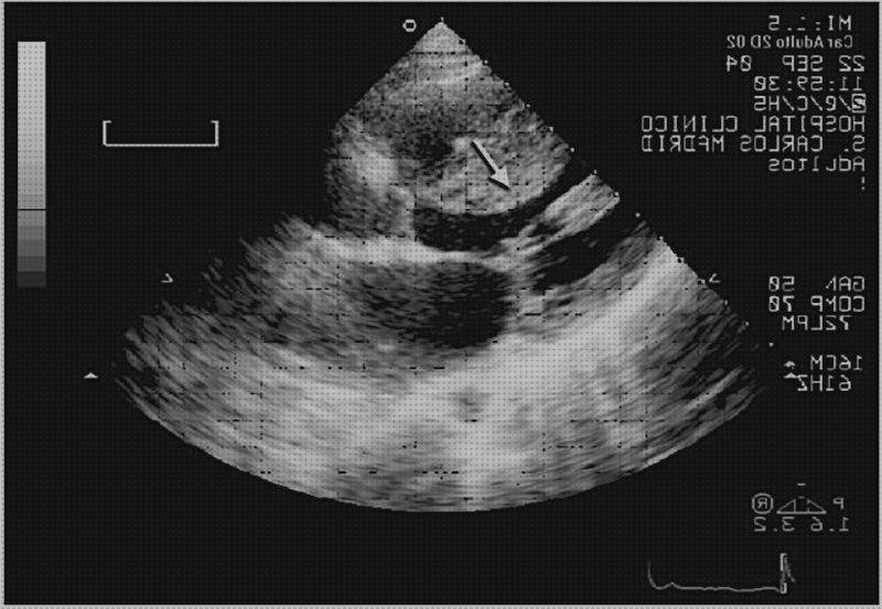 Opiniones de las 9 mejores Hipertrofias Ventricular Izquierdas Ecos Doppler