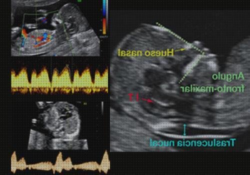 Los 12 Mejores Marcadores Ecograficos Sindrome De Down