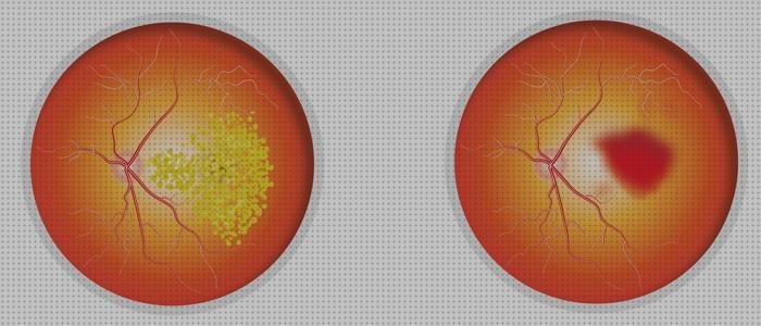 ¿Dónde poder comprar oftalmoscopia oftalmoscopia degeneracion macular?