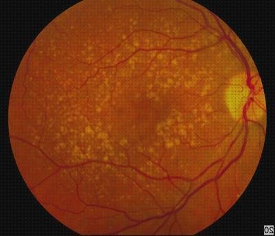 17 Mejores oftalmoscopia degeneracion macular para comprar