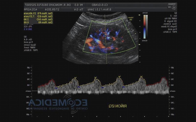 Opiniones de los 6 mejores Preparacion Para Ecos Doppler De Arterias Renales