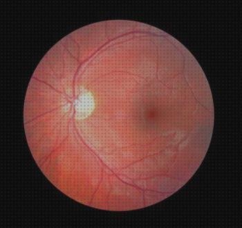 Las mejores oftalmoscopia retina oftalmoscopia