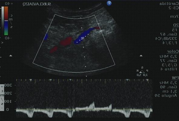 Mejores 20 subclavia médicos