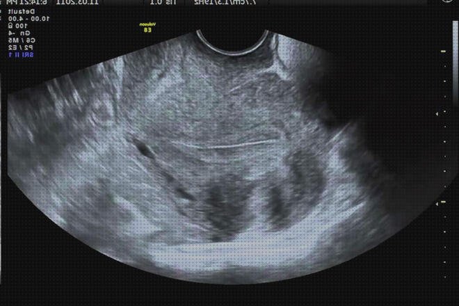 Análisis de los 22 mejores utero médicos bajo análisis
